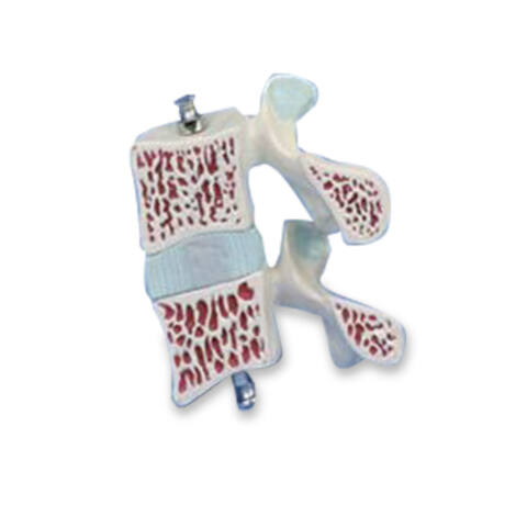 MODELO ANATÓMICO DE OSTEOPOROSIS, 2 VÉRTEBRAS - Imagen 2