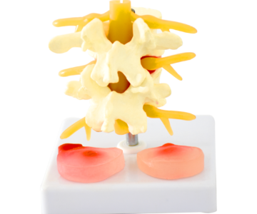 VÉRTEBRAS CON DISCO HERNIADO