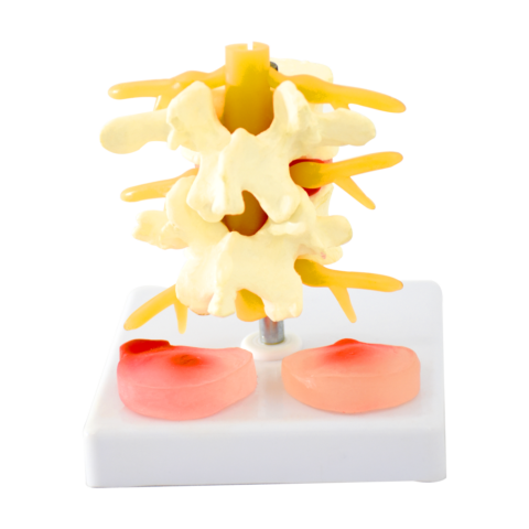 VÉRTEBRAS CON DISCO HERNIADO