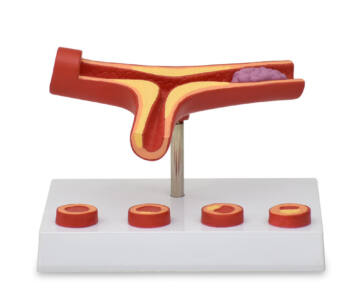 MODELO DE ARTERIOSCLEROSIS