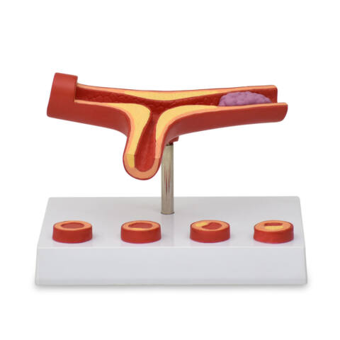 MODELO DE ARTERIOSCLEROSIS