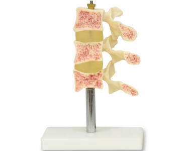 MODELO DE OSTEOPOROSIS, 3 VÉRTEBRAS CON BASE