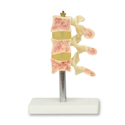 MODELO DE OSTEOPOROSIS, 3 VÉRTEBRAS CON BASE