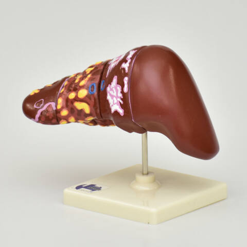 HIGADO CON PATOLOGIAS - Imagen 4