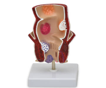 MODELO DE RECTO CON PATOLOGIAS