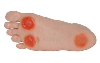 Pie diabético